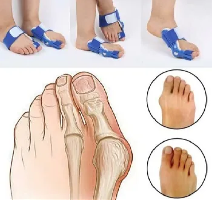 Adjustable Bunion Corrector Brace